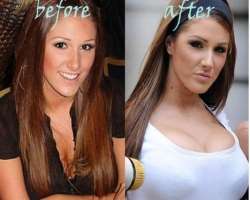 Lucy Pinder before surgery